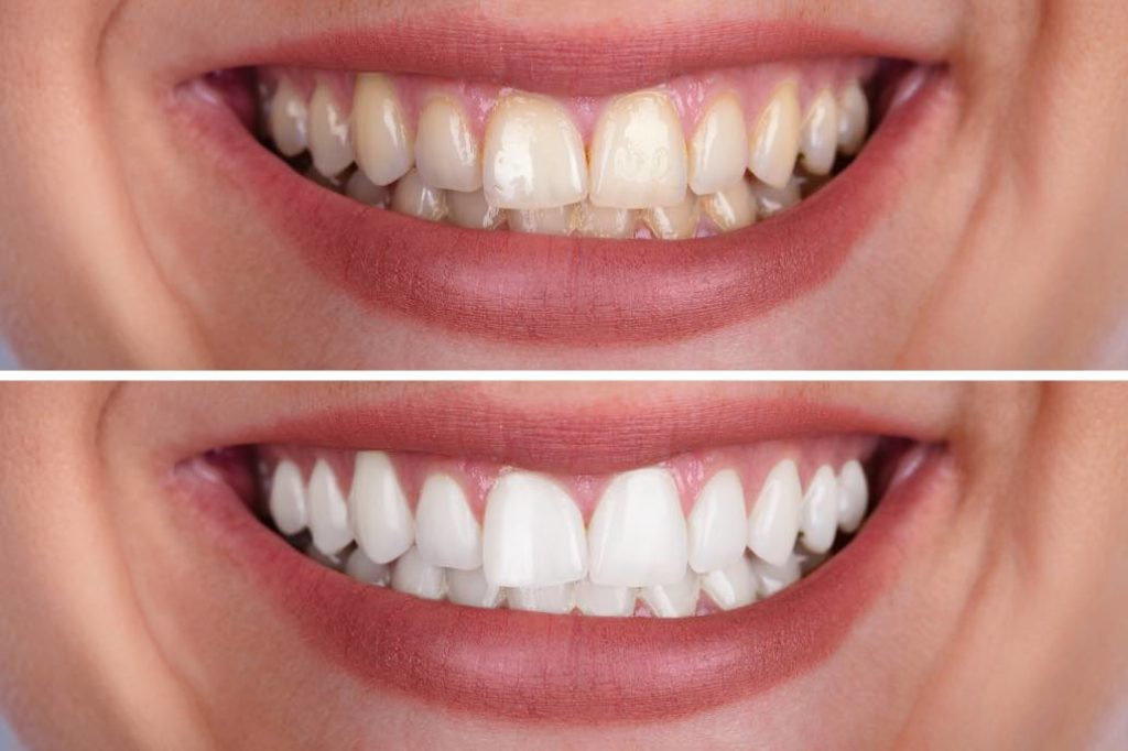 Professional teeth whitening at Maggie A. Kleem, DDS in Berea, Ohio